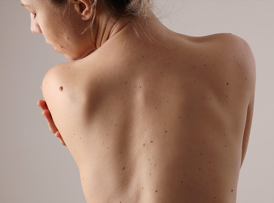 woman's bare back with sparse moles