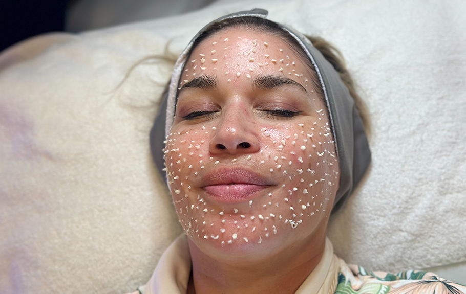 Cellstory liquid microneedling